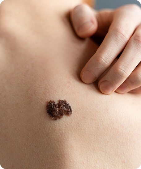 Close up of a mole check