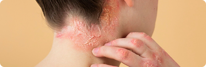 Skin condition treatment